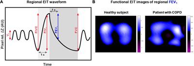 Spatial Ventilation Inhomogeneity Determined by Electrical Impedance Tomography in Patients With Chronic Obstructive Lung Disease